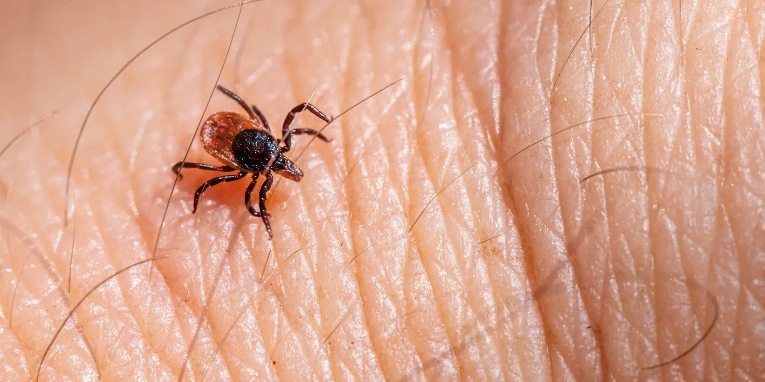 Zecca su pelle umana, esempio di infestazione da zecche.