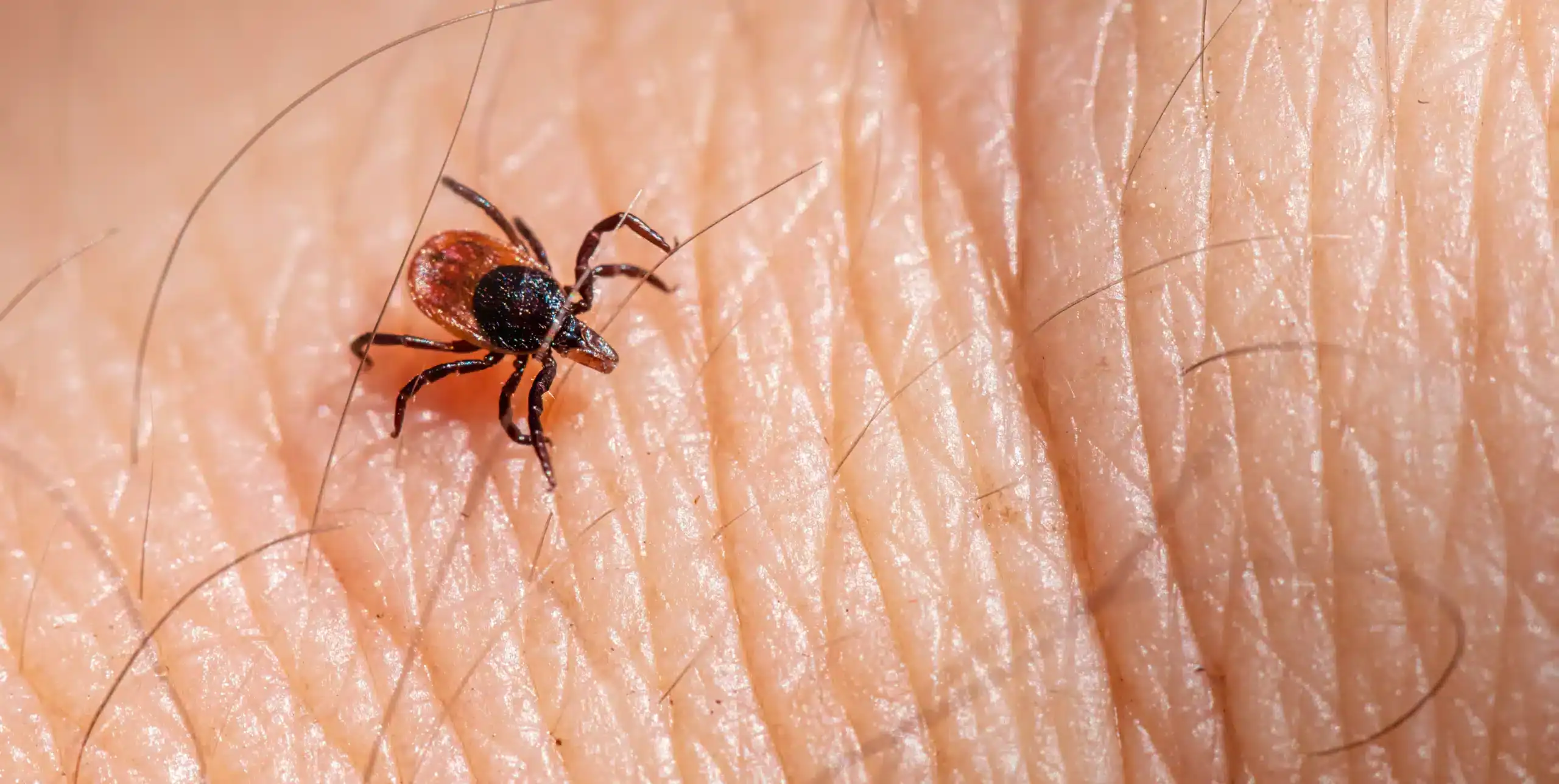 Zecca su pelle umana, esempio di infestazione da zecche.